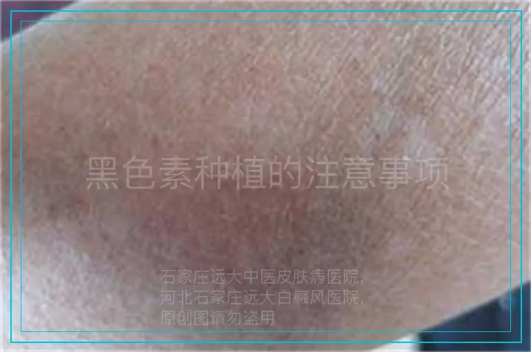 黑色素种植的注意事项