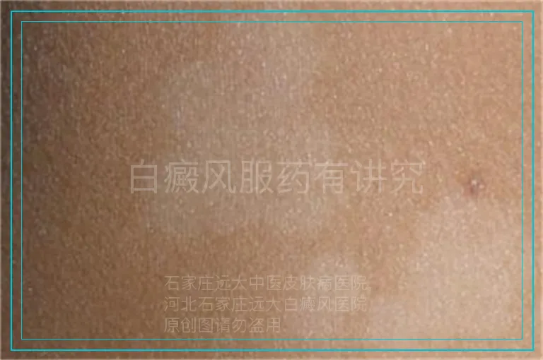 白癜风服药有讲究