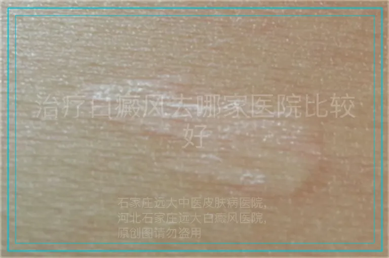 治疗白癜风去哪家医院比较好