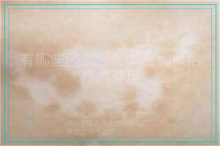 有哪些因素会影响白癜风治疗的费用