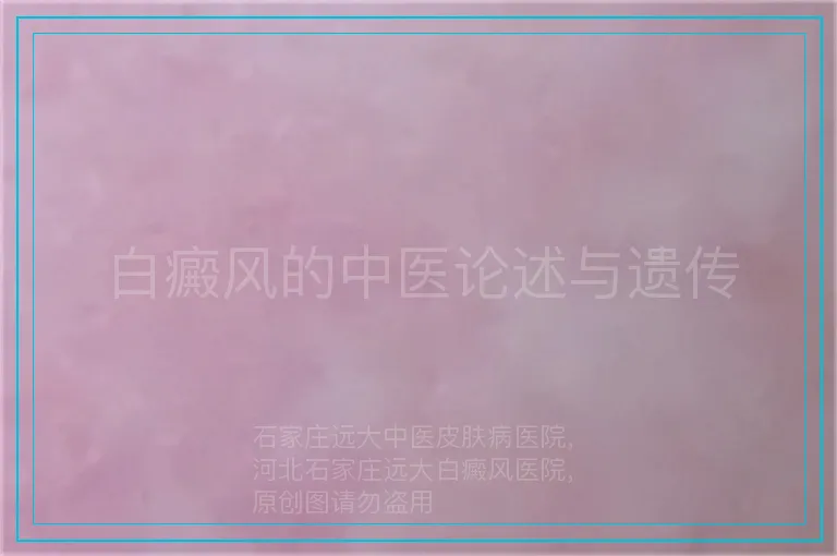 白癜风的中医论述与遗传