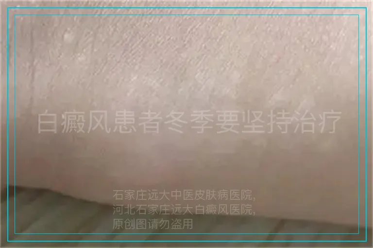 白癜风患者冬季要坚持治疗