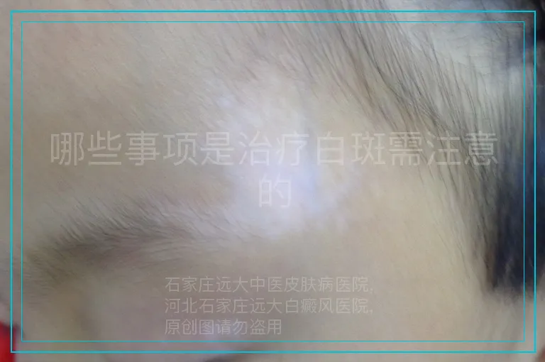 哪些事项是治疗白斑需注意的