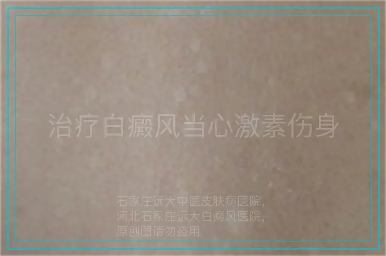 治疗白癜风当心激素伤身