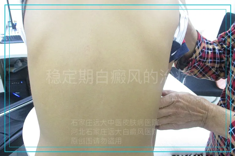 稳定期白癜风的治疗
