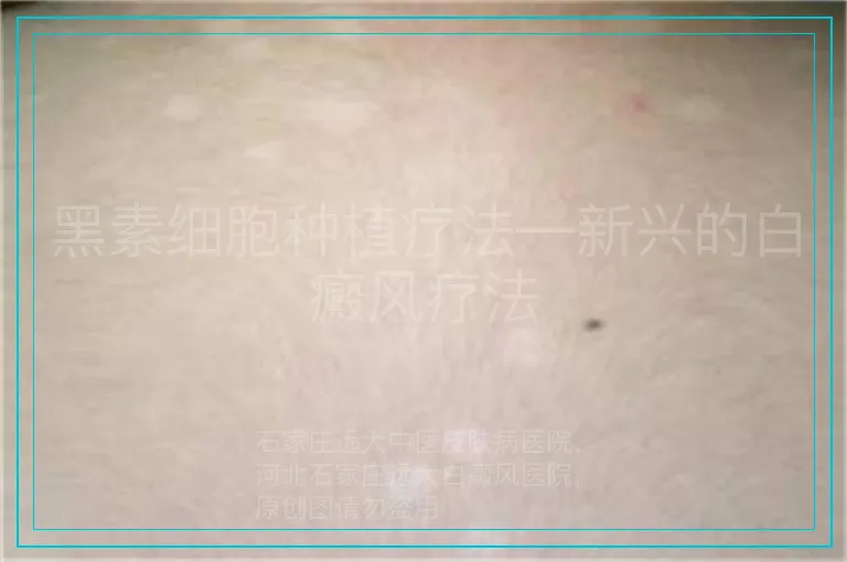 黑素细胞种植疗法—新兴的白癜风疗法