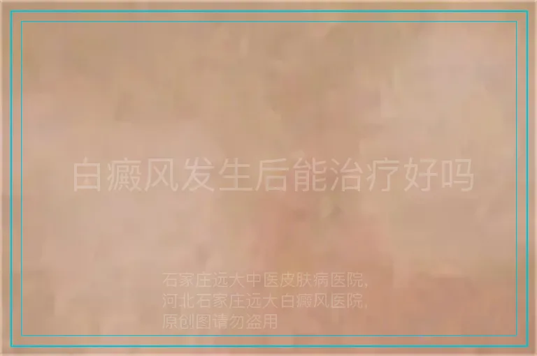 白癜风发生后能治疗好吗