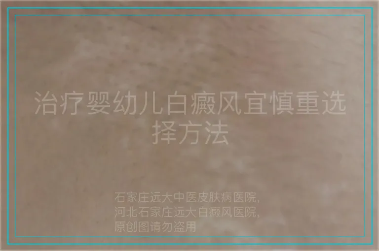 治疗婴幼儿白癜风宜慎重选择方法