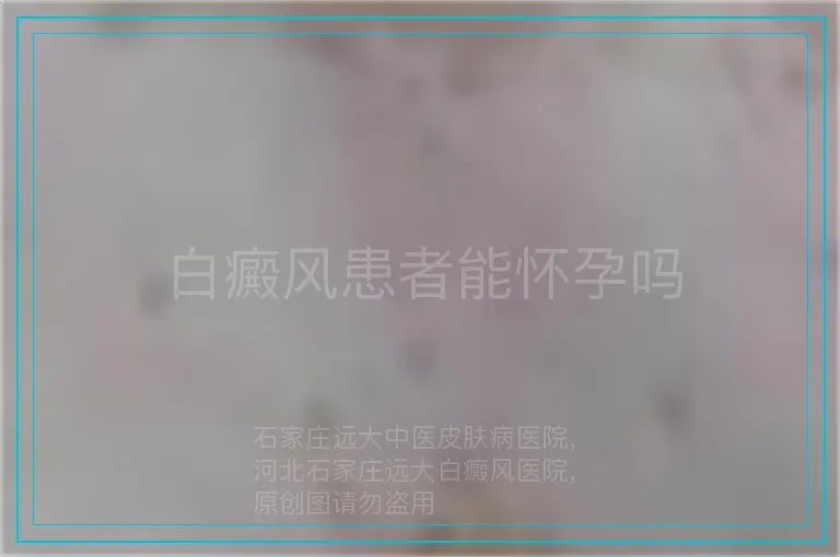 白癜风患者能怀孕吗