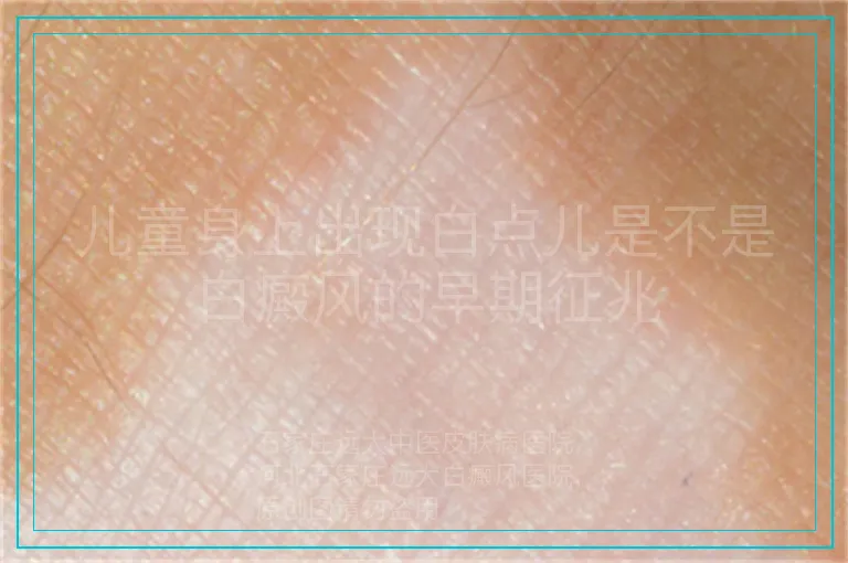 儿童身上出现白点儿是不是白癜风的早期征兆