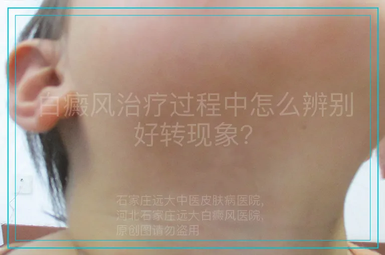 白癜风治疗过程中怎么辨别好转现象?