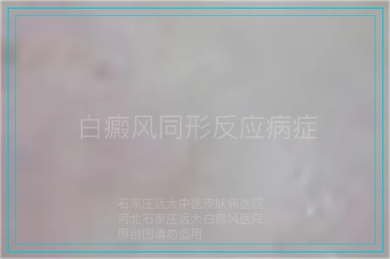 白癜风同形反应病症