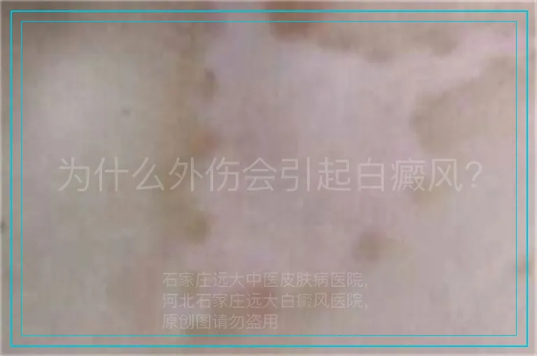 为什么外伤会引起白癜风?
