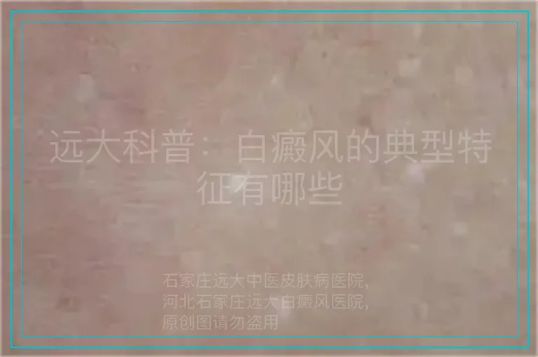 远大科普：白癜风的典型特征有哪些