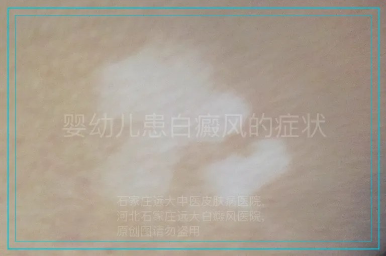 婴幼儿患白癜风的症状