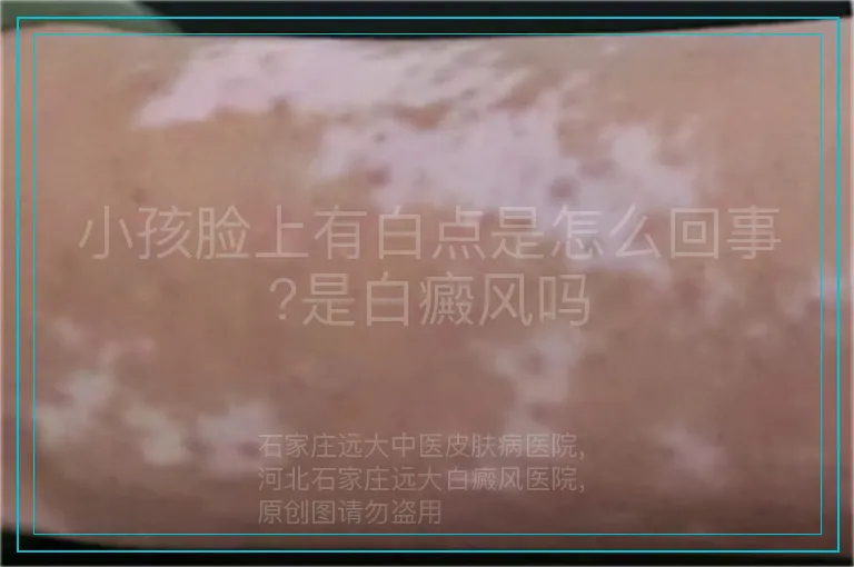 小孩脸上有白点是怎么回事?是白癜风吗