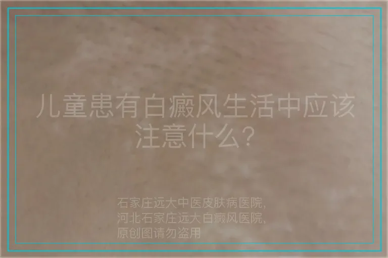 儿童患有白癜风生活中应该注意什么?
