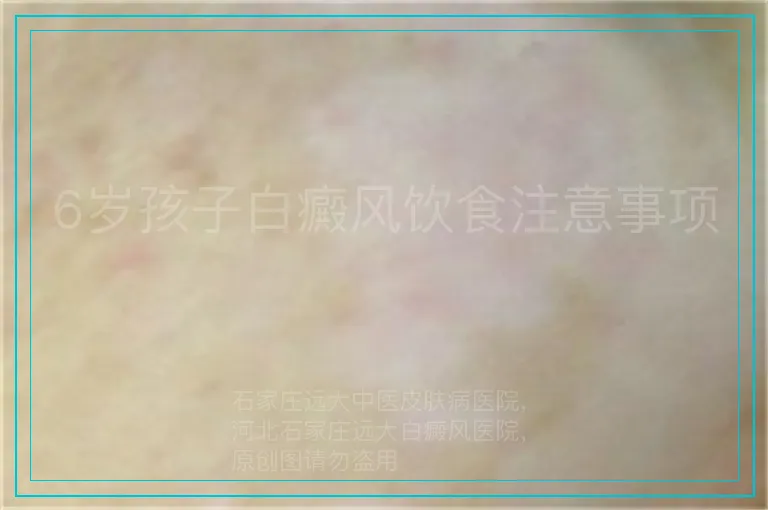 6岁孩子白癜风饮食注意事项