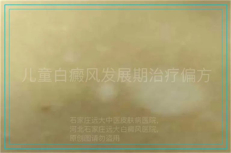 儿童白癜风发展期治疗偏方