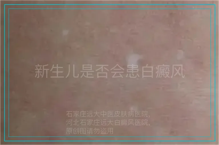 新生儿是否会患白癜风