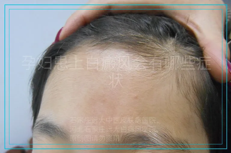 孕妇患上白癜风会有哪些症状