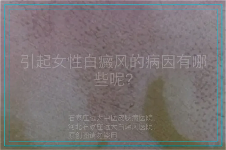 引起女性白癜风的病因有哪些呢?
