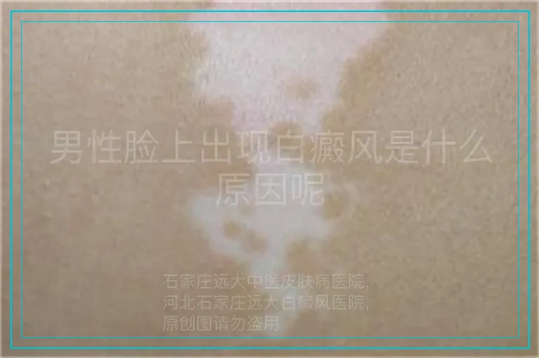 男性脸上出现白癜风是什么原因呢