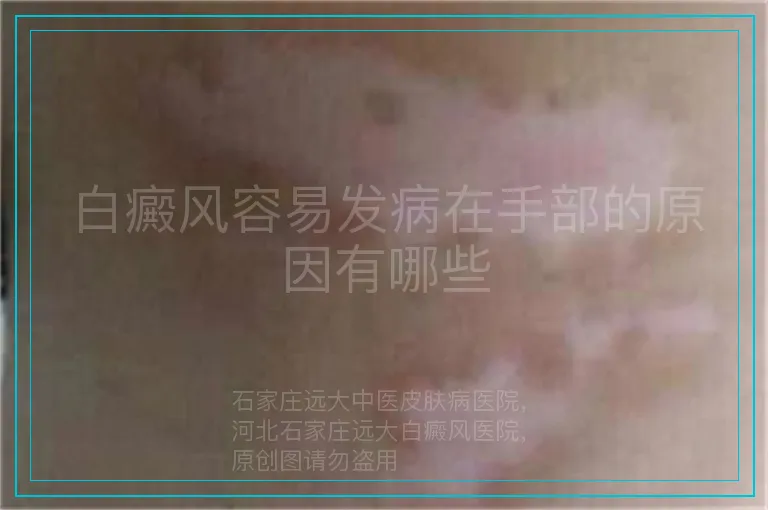 白癜风容易发病在手部的原因有哪些