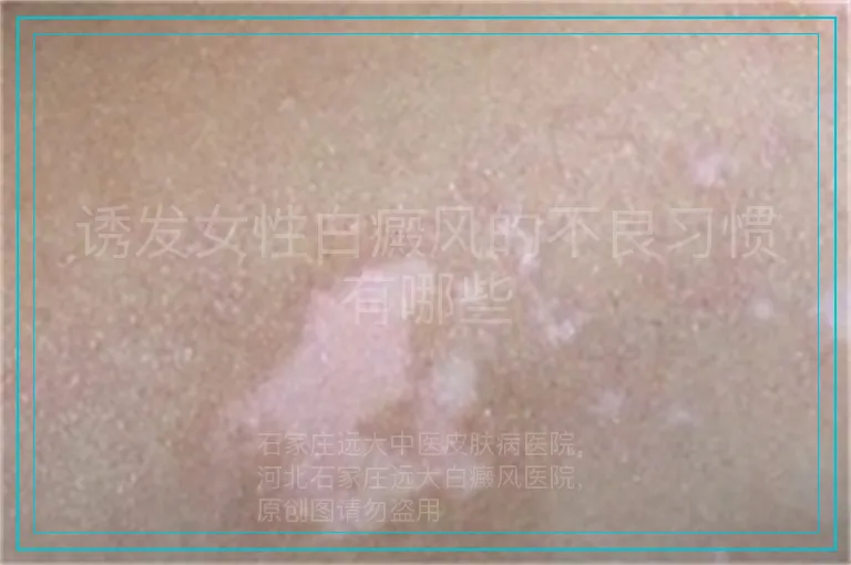 诱发女性白癜风的不良习惯有哪些