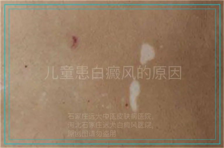 儿童患白癜风的原因