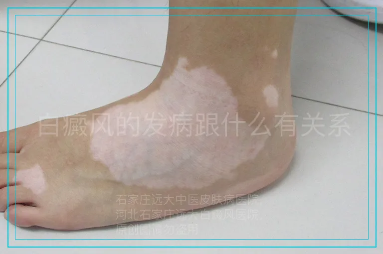 白癜风的发病跟什么有关系