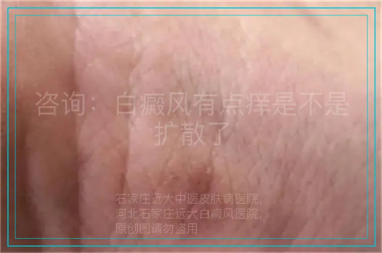 咨询：白癜风有点痒是不是扩散了
