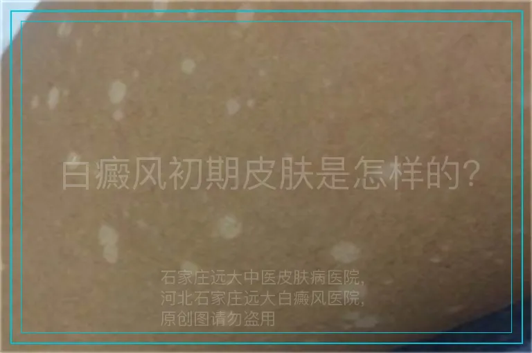 白癜风初期皮肤是怎样的?