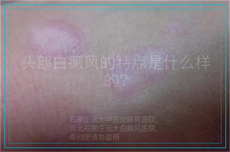 头部白癜风的特点是什么样的?