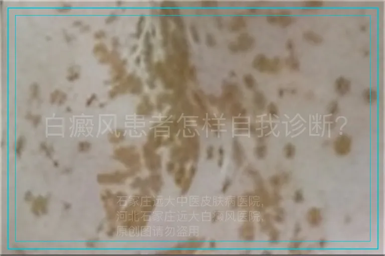 白癜风患者怎样自我诊断?