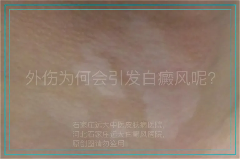 外伤为何会引发白癜风呢?