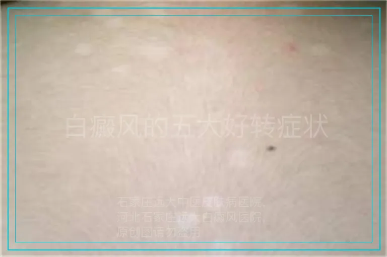 白癜风的五大好转症状