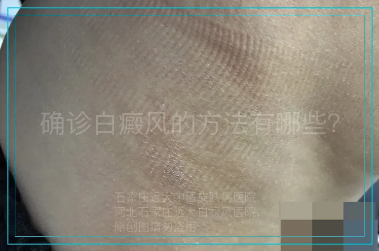 确诊白癜风的方法有哪些？