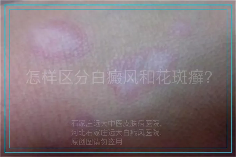 怎样区分白癜风和花斑癣？