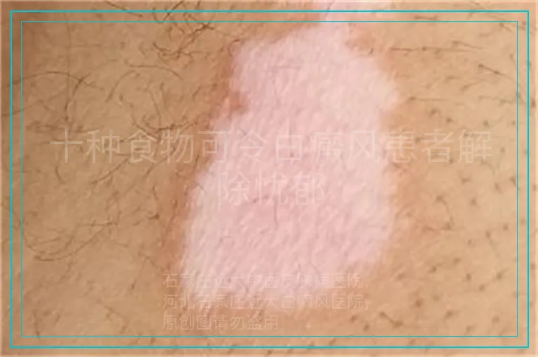 十种食物可令白癜风患者解除忧郁
