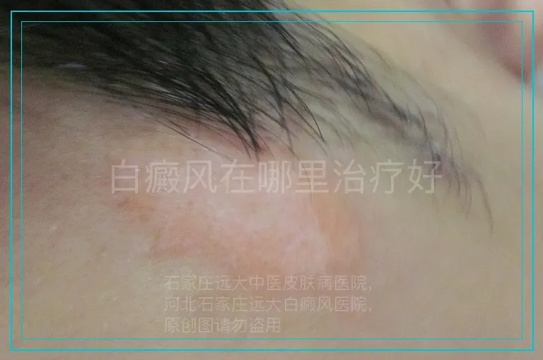 白癜风在哪里治疗好