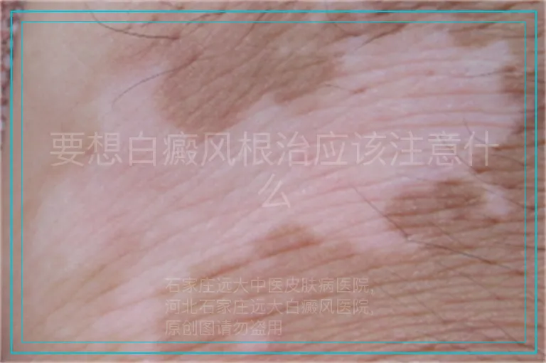 要想白癜风根治应该注意什么