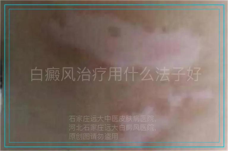 白癜风治疗用什么法子好
