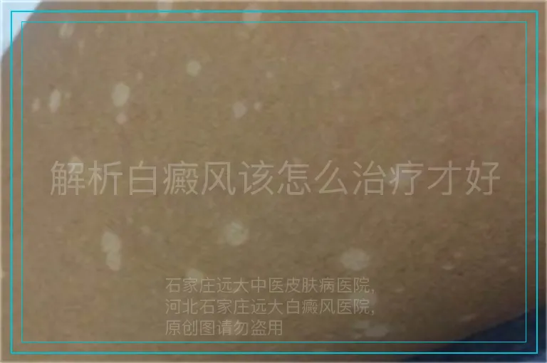解析白癜风该怎么治疗才好