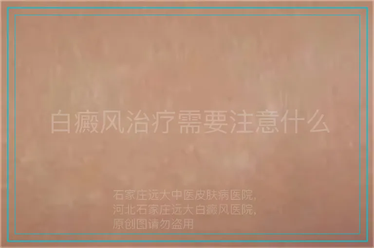 白癜风治疗需要注意什么