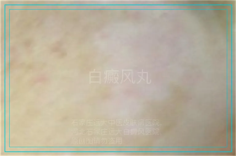 白癜风丸