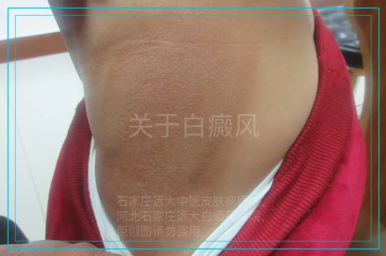 关于白癜风