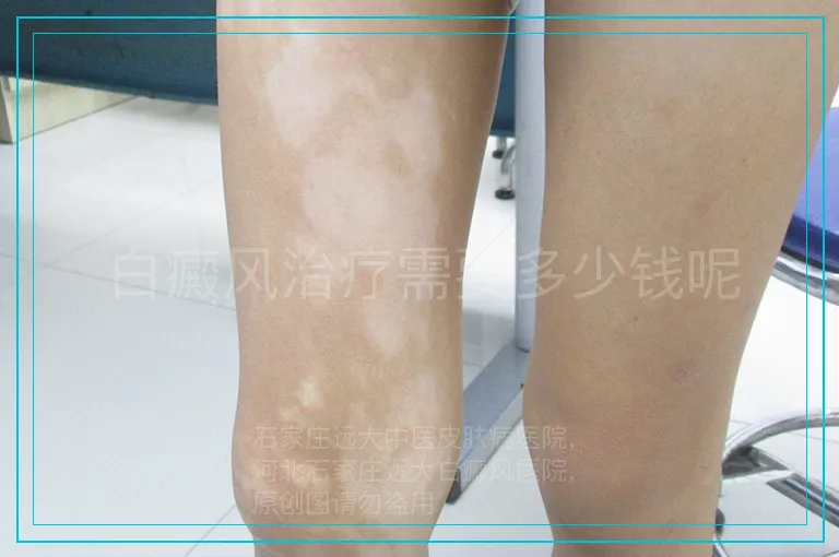 白癜风治疗需要多少钱呢