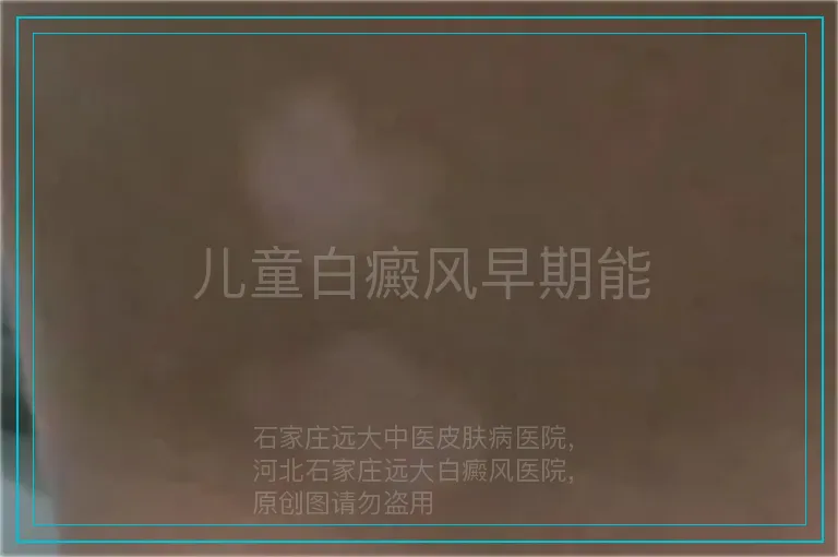儿童白癜风早期能