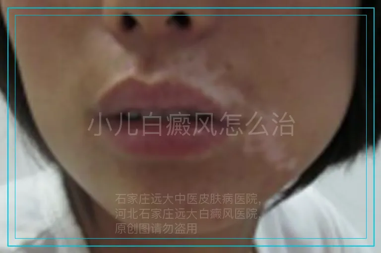 小儿白癜风怎么治